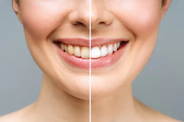 Teeth Whitening And Bleaching