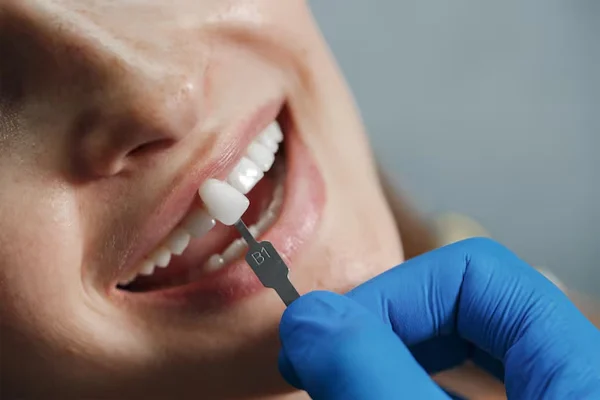 Laminate And Veneers