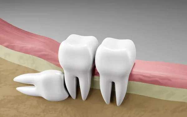 Wisdom Tooth Surgery